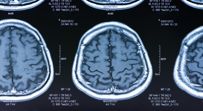 Brain Tumour Types Featured Image