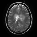 Anaplastic Astrocytoma Featured Image