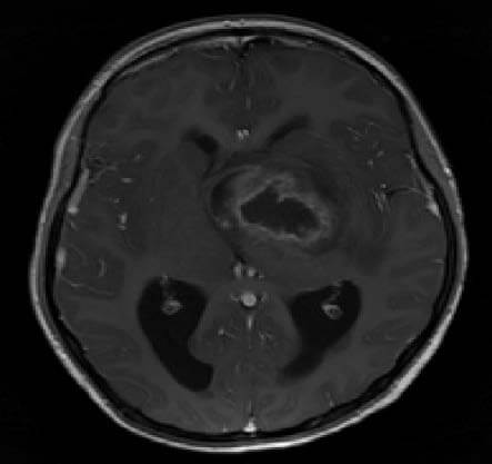 Astrocytoma – An Overview Featured Image