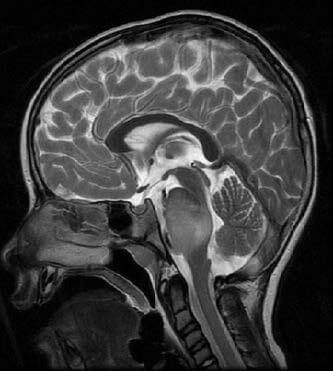 Diffuse Midline Glioma Featured Image