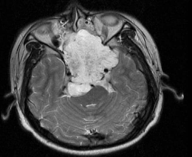 Chordoma Featured Image