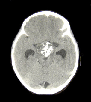 Craniopharyngioma Featured Image