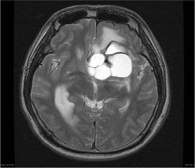 Ependymoma Featured Image