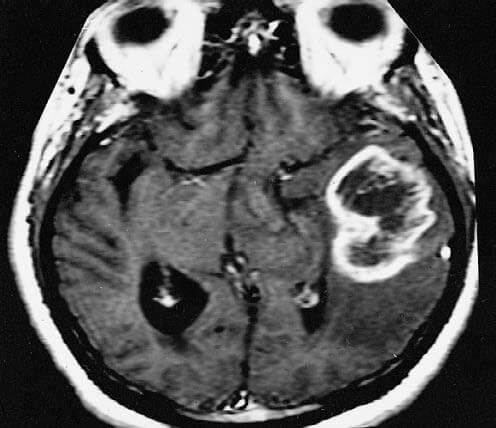 Glioblastoma (GB) Featured Image