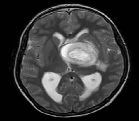 Pilocytic Astrocytoma Featured Image