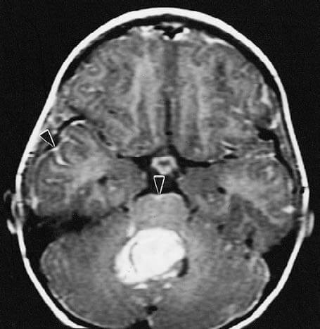 Médulloblastome Featured Image