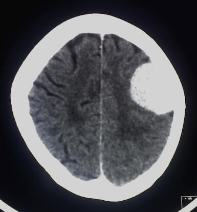 Meningioma Featured Image