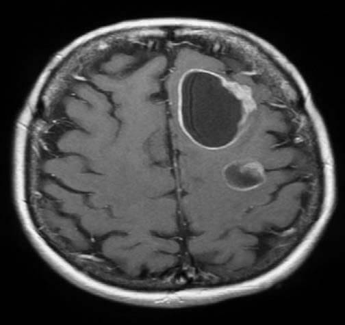 Metastatic Brain Tumours Featured Image