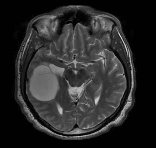 Oligodendroglioma Featured Image