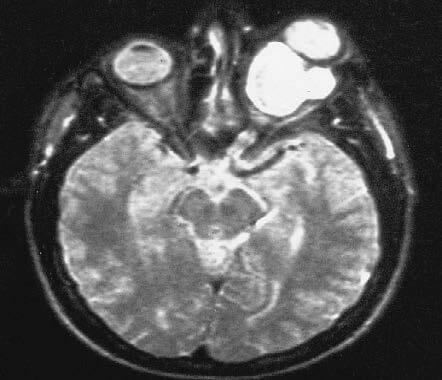 Optic Pathway Glioma Featured Image