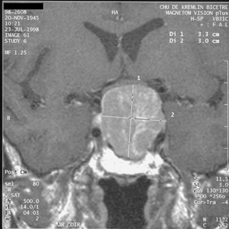 Pituitary Adenomas Featured Image