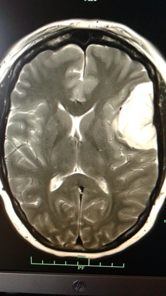 Laura's meningioma