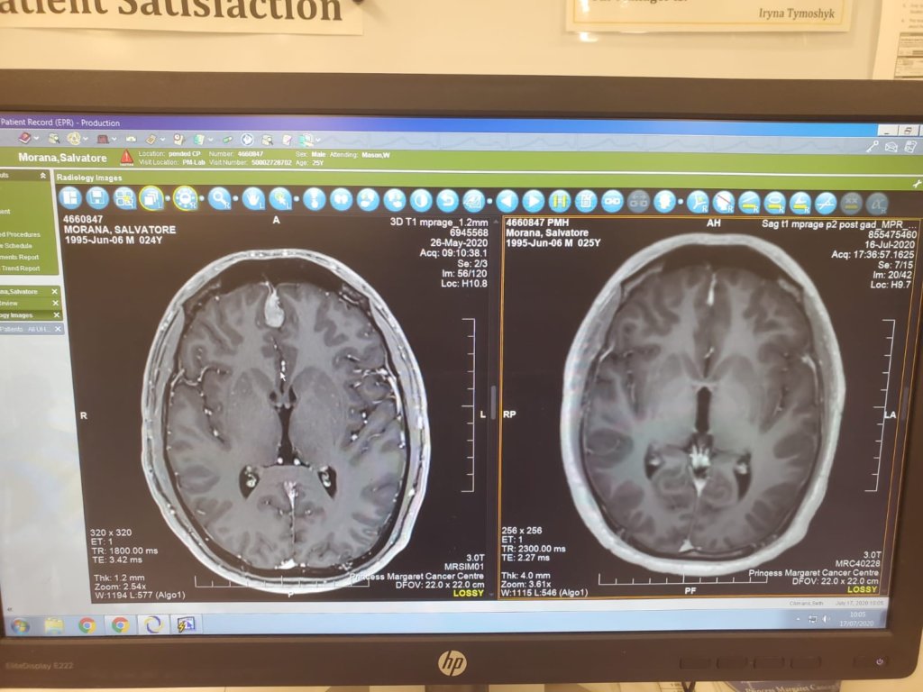 Brain tumour before and after gamma knife treatment.