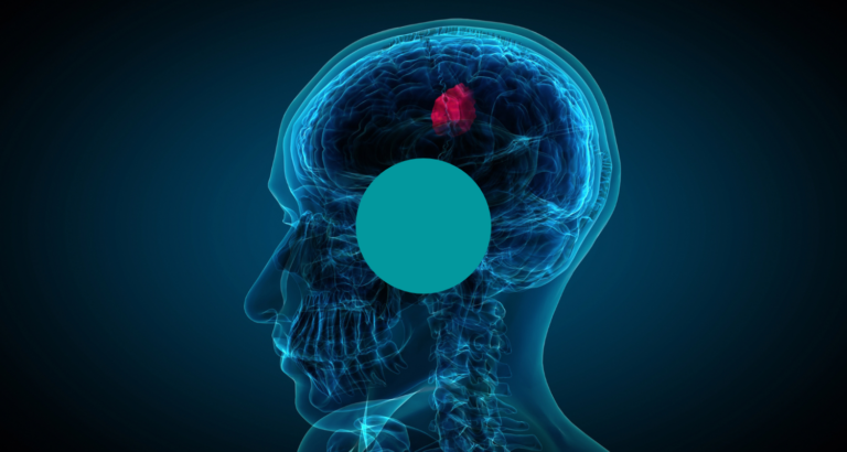 Non-Malignant Brain Tumours Featured Image