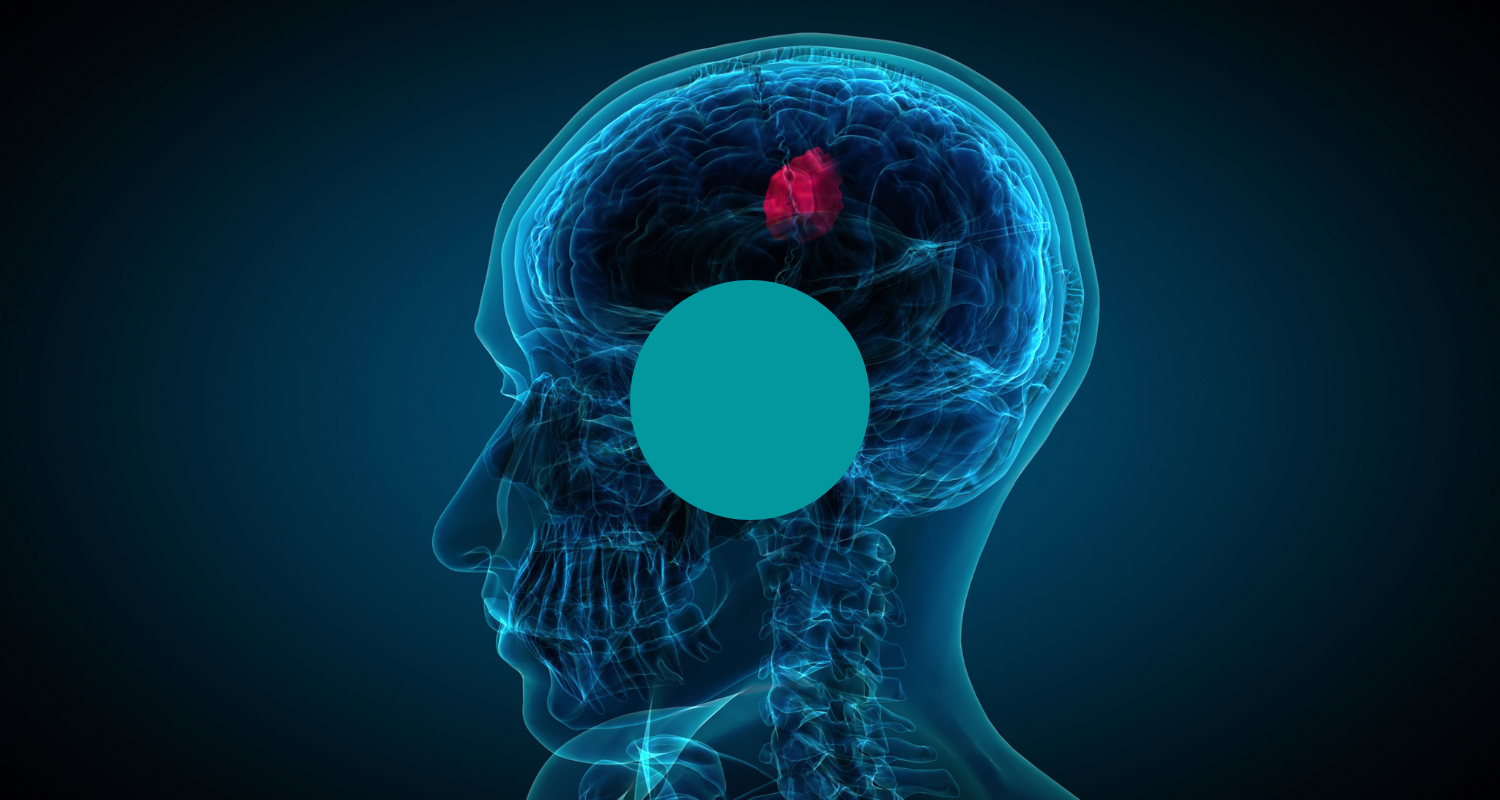 Are Malignant Brain Tumors Always Fatal